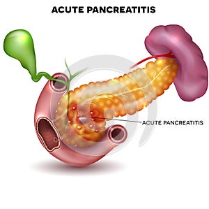 Pancreatitis