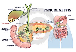 Pancreatitis as pancreas inflammation from chronic gallstones outline diagram photo