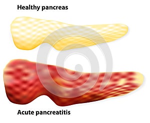 Pancreatitis. The differences between healthy pancreas and inflamed pancreas