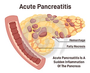 Pancreatitis disease. Pain and inflammation in human internal