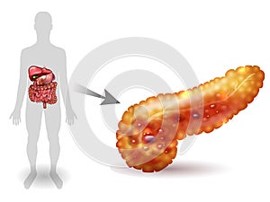 Pancreatitis illustration photo