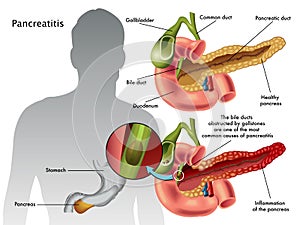 Pancreatitis photo