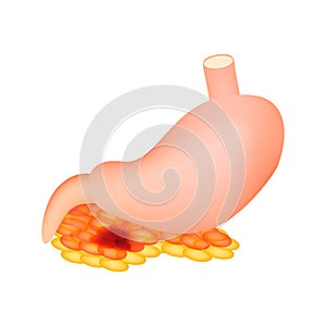 Pancreatitis. The structure of the stomach and pancreas. Infographics. Vector illustration on isolated background.