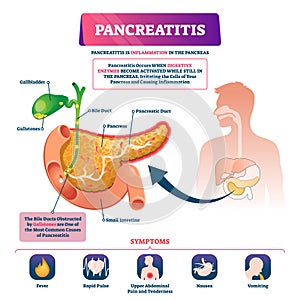 Pancreatitis vector illustration. Labeled sick pancreas inflammation scheme photo