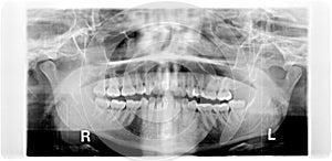 panorama of damaged jaw erosion of the joint TMJ