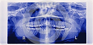 panorama of damaged jaw erosion of the joint TMJ