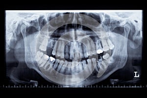 Panorama x-ray image of a human jaw