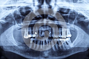 Panorama x-ray image of a human jaw