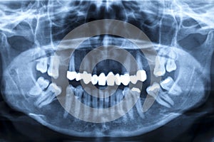 Panorama x-ray image of a human jaw