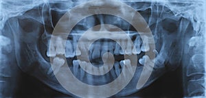 Panoramic dental and mandible x-ray