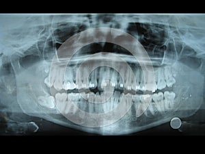 Panorámico radiología deslizarse 