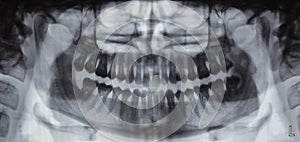 Panoramic dental X-ray - 31 teeth