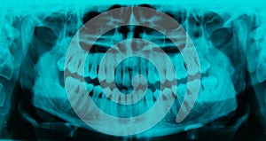 Panoramic dental X-ray - 31 teeth cyan color