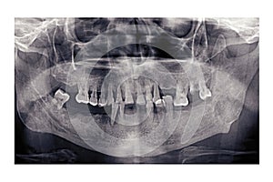 Panoramic dental x-ray of an elderly person. Bad teeth fell out. Snapshot of the pensioner`s jaw. Orthopantomogram