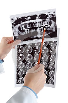 Panoramic dental X-Ray in hand.