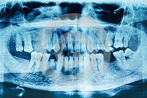 Panoramic dental x-ray image of teeth. Detail.