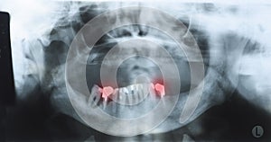 Panoramic dental x-ray of an old person with some lower teeth an