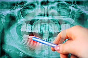 Panoramic dental teeth x-ray
