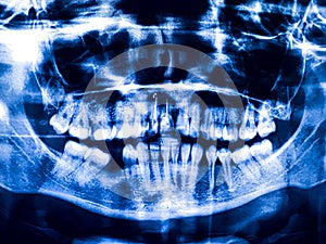 Panoramic dental tooth X-ray. Radiography for dental structures research concept