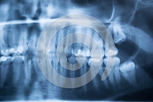 Panoramic Dental X-Ray Of Human Teeth