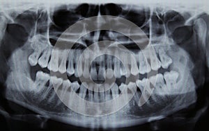 Panoramic dental Xray