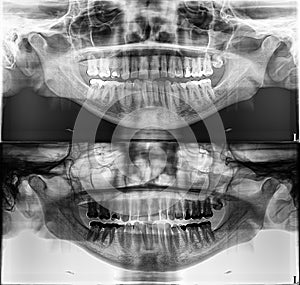 Panoramic dental Xray, fixed teeth, dental amalgam seal, wisdom tooth on side, horizontally impacte