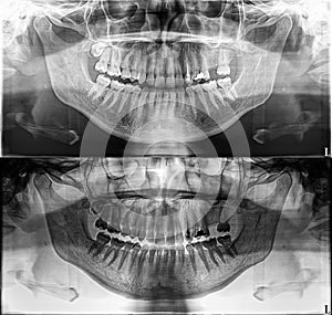 Panoramic dental Xray, fixed teeth, dental amalgam seal, dental crown and bridge, filled root canal wisdom tooth impacted