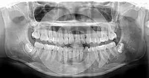 Panoramic dental Xray shows fixed teeth amalgam seal.X-ray for dental problems in toothache patient or trauma