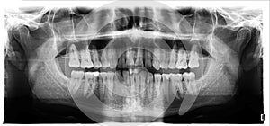 Panoramic image of the jaw, primary adentia of the third molar. Medical examination of teeth, maxillofacial surgery