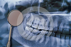 Panoramic jaw x-ray with dental mirror. Dental treatment concept. Closeup.