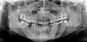 Panoramic radiograph is a panoramic scanning dental X-ray of the maxilla and mandible photo