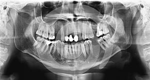 Panoramic radiograph is a scanning dental X-ray jaws of young man