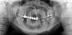 Panoramic radiograph is a panoramic scanning dental X-ray of the maxilla and mandible photo