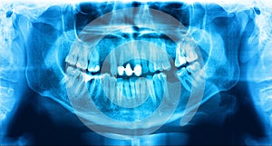 Panoramic radiograph is a scanning dental X-ray jaws of young man photo