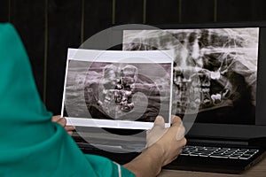 Panoramic X-ray of children`s teeth of two jaws, orthopantomogram of children`s teeth on laptop screens at the doctor`s table