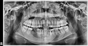 Panoramic scanning dental X-ray of the upper and lower jaw Orthopantomogram or OPG
