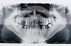 Panoramic x-ray skan