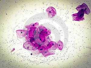 Pap\'s smear microscopic showing severe inflammatory epithelial cells.