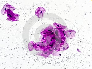 Pap\'s smear microscopic showing severe inflammatory epithelial cells.