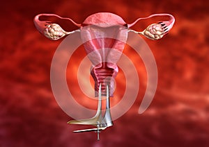 Porridge macchia è un ginecologico visita medica da cervicale esegue come prevenzione da cervicale cancro 