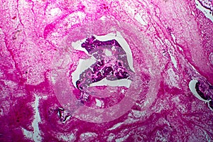 Papillary serous ovarian adenocarcinoma, light micrograph