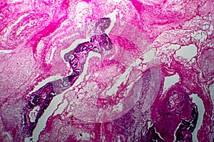 Papillary serous ovarian adenocarcinoma, light micrograph