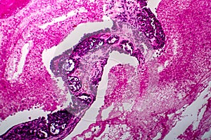 Papillary serous ovarian adenocarcinoma, light micrograph