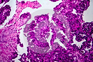 Papillary serous ovarian adenocarcinoma, light micrograph