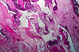 Papillary serous ovarian adenocarcinoma, light micrograph photo