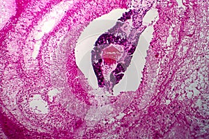 Papillary serous ovarian adenocarcinoma, light micrograph photo