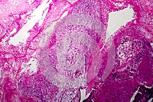 Papillary serous ovarian adenocarcinoma, light micrograph photo