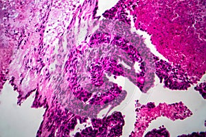 Papillary serous ovarian adenocarcinoma, light micrograph photo