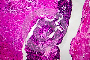 Papillary serous ovarian adenocarcinoma, light micrograph photo