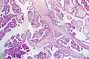 Papillary thyroid cancer, light micrograph